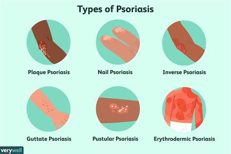 Plaque Psoriasis Scalp Home Remedy - Homemade Ftempo