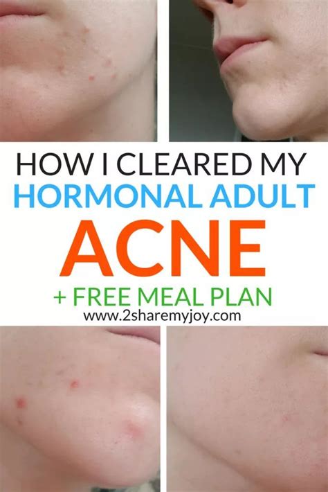 Hormonal Acne Diet Plan {best 7-day clear skin meal plan PDF} | Acne ...