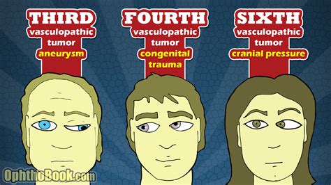 4th Cranial Nerve Palsy Exercises - fingersandfeathersh