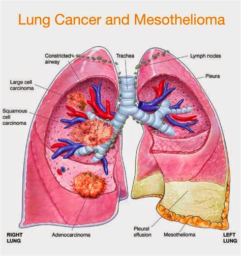 Medical Treatment Pictures-for Better Understanding: Malignant ...