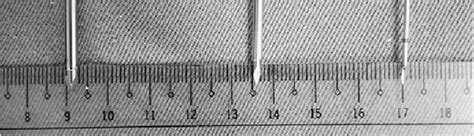 Figure 2 from The Use of Somatex Shunt for Fetal Pleural Effusion: A ...