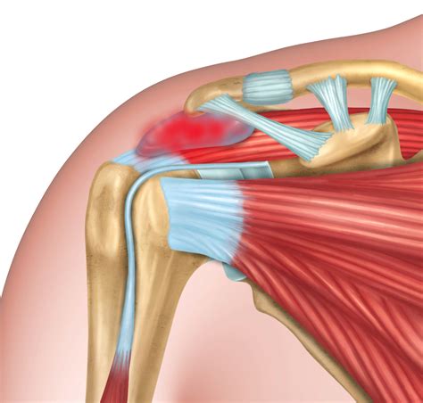 Orthopaedic & Trauma Surgeon - Shoulder - Subacromial bursitis