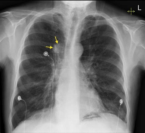 Lung cancer - CXR - Radiology at St. Vincent's University Hospital