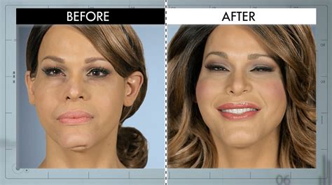 Botched Plastic Surgery Before And After Body