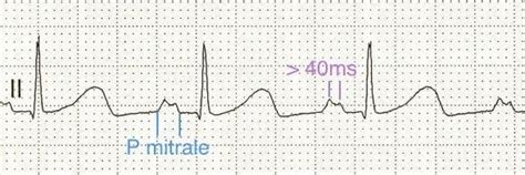 Left Atrial Enlargement • LITFL Medical Blog • ECG Library Basics