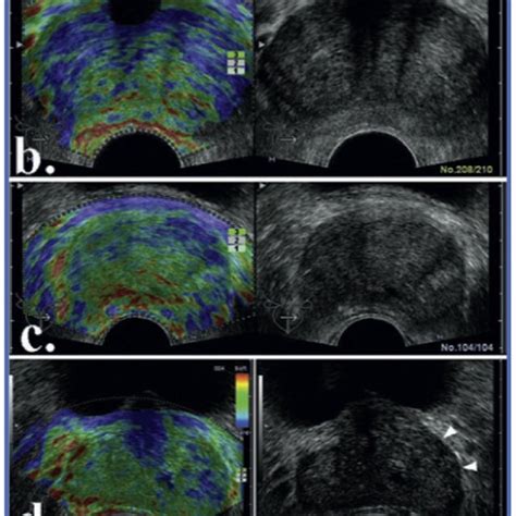 (a) Transrectal ultrasound B-mode image shows irregular hypoechoic ...