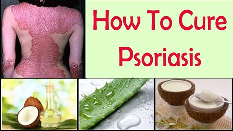 How To Cure Psoriasis Permanently With Natural Home Remedies - YouTube