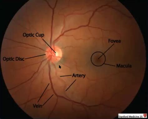 Oftalmología - Enfermedades de la retina Flashcards | Quizlet