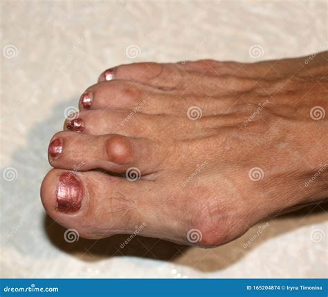 A Bone on the Foot. Bump on the Toe. Stock Photo - Image of ...