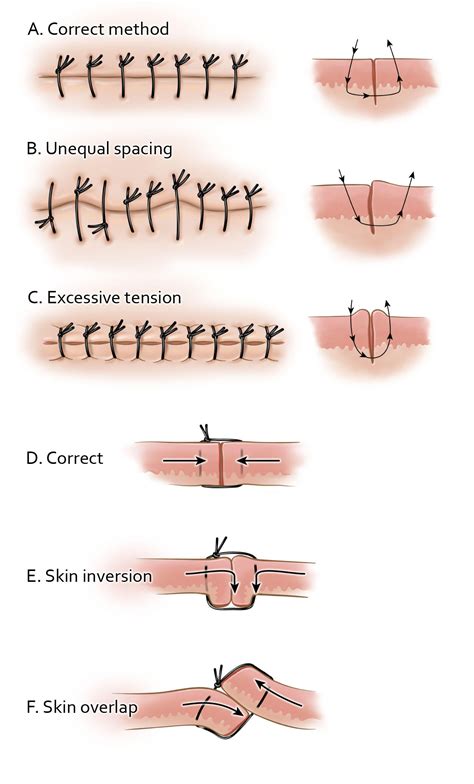 Suturing and Closure | The Neurosurgical Atlas, by Aaron Cohen-Gadol, M.D.