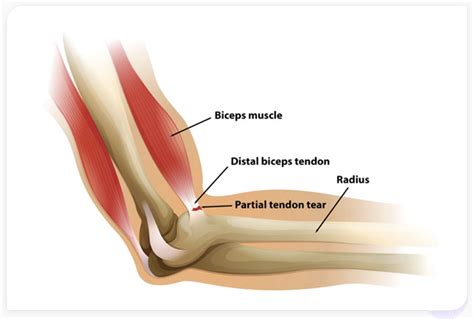 Distal Biceps Tendon Tears| Advanced Regenerative Medicine