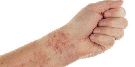 When Does a Chlamydia Skin Rash Occur? - Flash Uganda Media