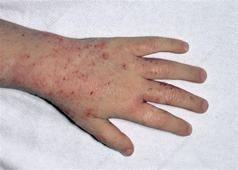 Eczema Rash On Hands