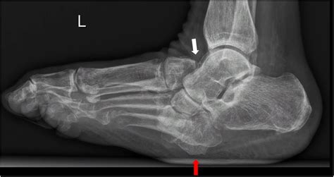 Charcot foot 101: Definition, Stages, Symptoms, and Diagnosis