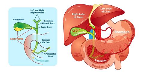 Bile Duct Obstruction: Symptoms, Causes & Treatments