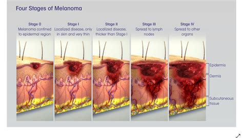 Melanoma: How To Catch Skin Cancer Early (Mayo) | Doctors Without ...