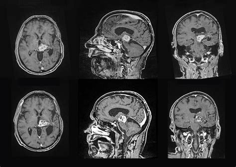 This is your brain on … surgical sound waves | Fortune