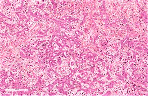 Cholangiocarcinoma Histology