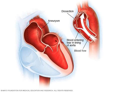 Aneurisma de la aorta - Síntomas y causas - Mayo Clinic