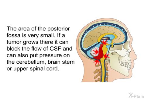 Posterior Fossa Craniotomy