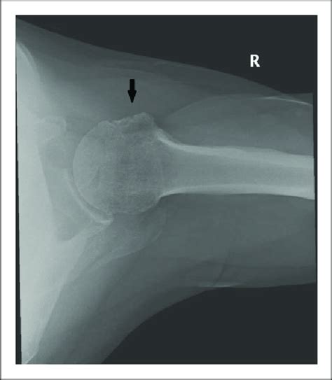 An axial radiograph of a right shoulder demonstrating greater ...