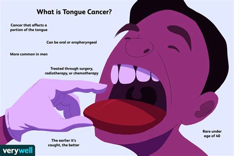 Tongue Cancer Symptoms, Causes, Diagnosis, and Treatment