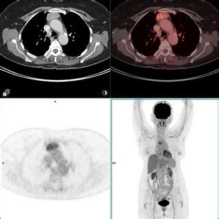 Type A thymoma. Anterior mediastinal mass that was pathologically ...