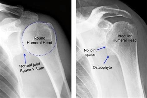 Boston Shoulder Institute – normal v arthritis 1(2)