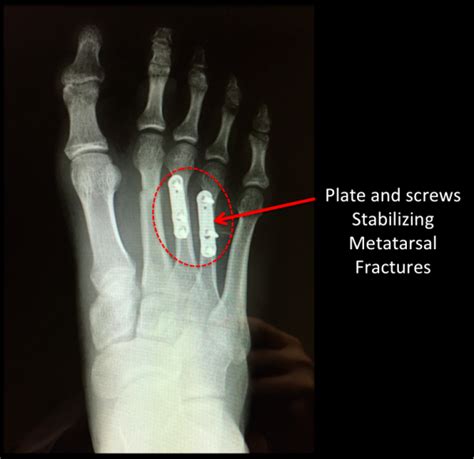 Metatarsal Shaft Fractures - FootEducation