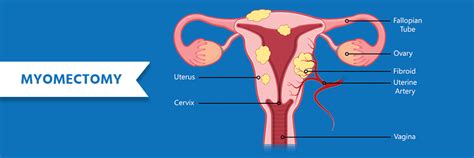 Myomectomy Surgery: Cost, Types, Procedure, and Benefits