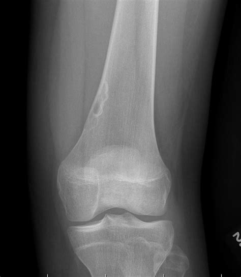 Non-Ossifying Fibroma | The Bone School