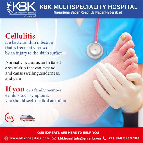 Cellulitis Treatment - KBK Hospitals - Medium