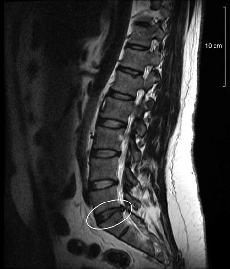 Spinal-disc-protrusion-l5 – Chiropractor Laguna Hills | Lakeview ...