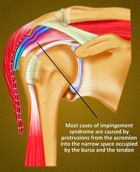 Impingement Syndrome – Back In Action