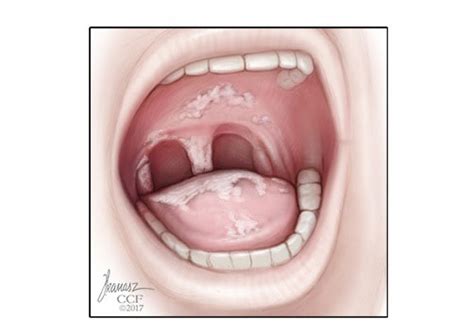 Thrush: Symptoms, Causes & Treatment