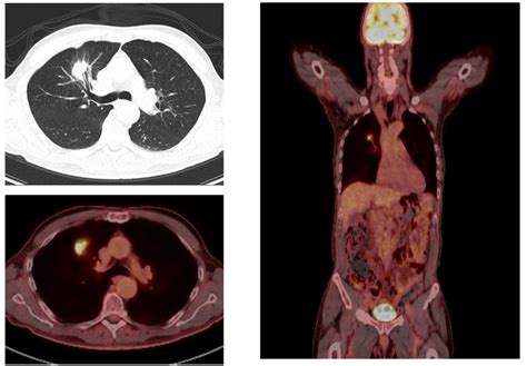 PET/CT For Non-Small Cell Lung Cancer Detection and Staging - Charter ...