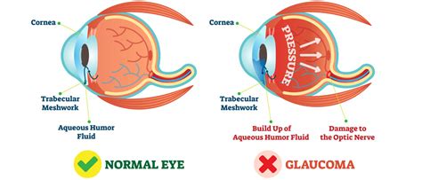 Newly Diagnosed with Glaucoma? Here are some treatment options.