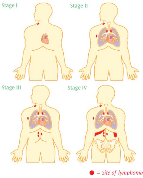 Non-Hodgkin Lymphoma Staging - Understand the Different Stages