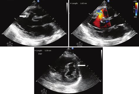 Ventricular Septal Defect