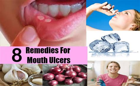 8 Home Remedies to Treat Mouth Ulcers Naturally | Best Herbal Health