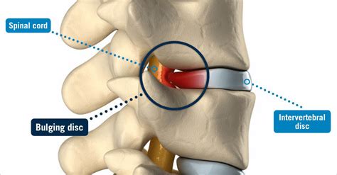 Bulging Disc - USA Spine Care - Laser Spine Surgery