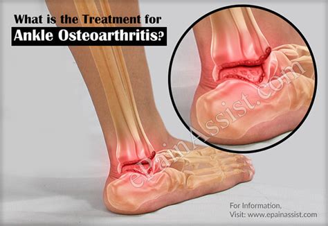 Ankle Osteoarthritis|Causes|Symptoms|Treatment|Recovery|Diagnosis