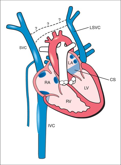 What Does The Coronary Sinus Drain Into - Best Drain Photos Primagem.Org