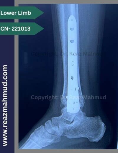 Bimalleolar Fracture | ORIF [221013] - Dr. Reaz Mahmud