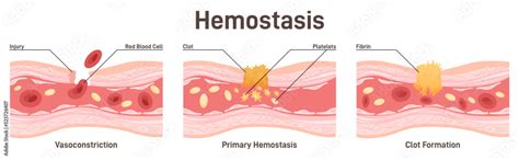 Hemostasis. Wound healing process stages, vasoconstriction and Stock ...