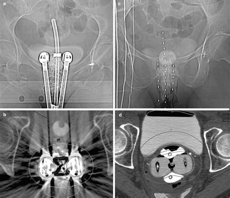 Image-Guided Brachytherapy | Radiology Key