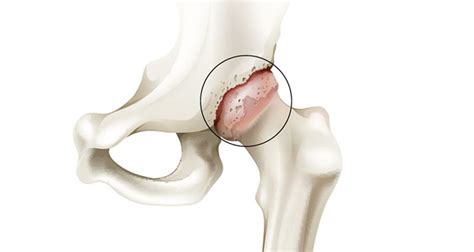 Osteoarthritis Hip Pain