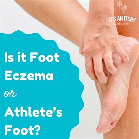 Is it Foot Eczema or Athlete’s Foot? | Natural cough remedies, Herbal ...