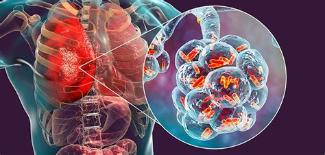 Nontuberculous mycobacteria lung disease | UT Health East Texas