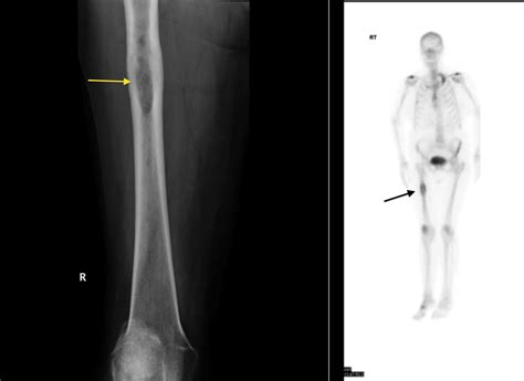 Bone metastasis - Radiology at St. Vincent's University Hospital